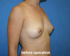 plastic-surgery-breast-augmentation